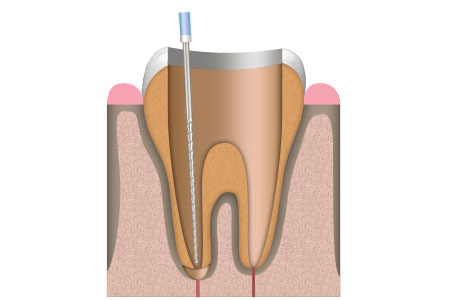 Dt. Sezen Ilter Aydogan | Canal Treatment